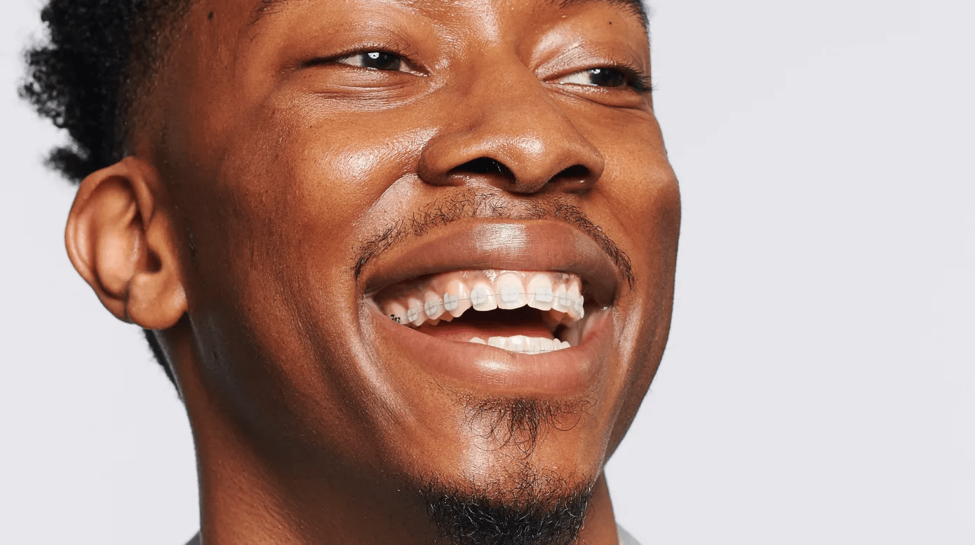 LightForce Clear Braces