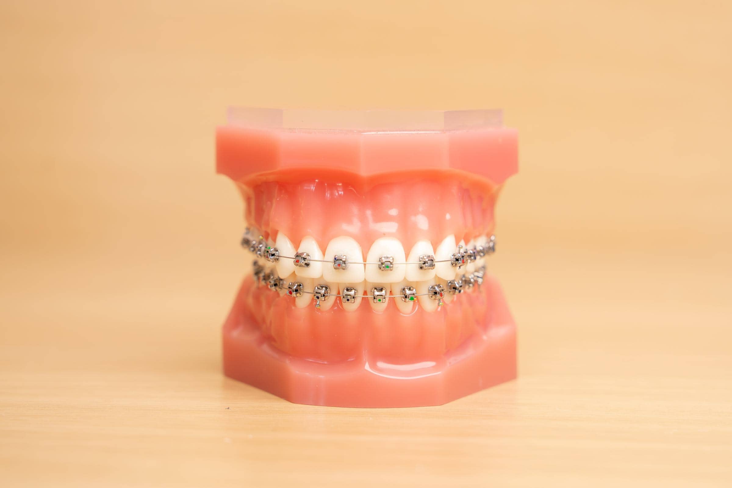 Metal Braces