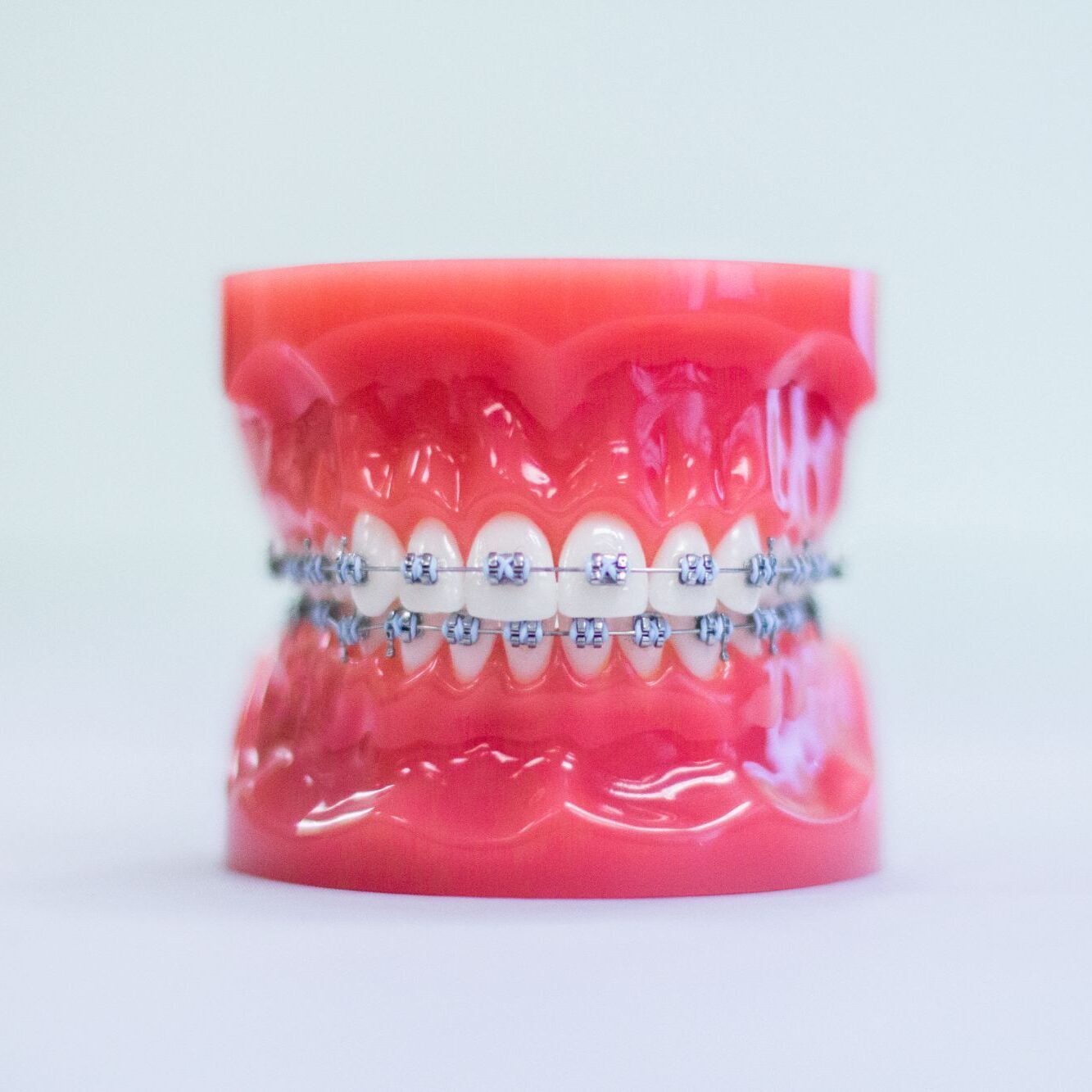 Metal braces at orthodontist atascadero ca